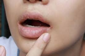 How to heal cracked lip corners fast